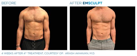 emsculpt chula vista|Emsculpt San Diego .